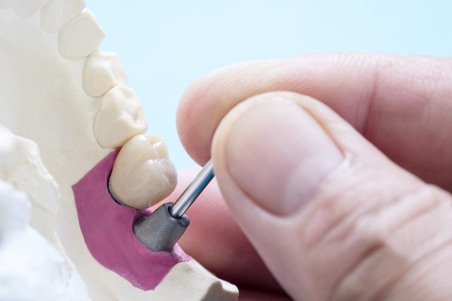 Clínica dental con implantes dentales en Leganés